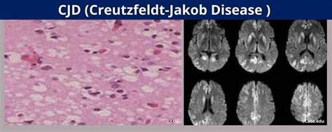 cjdbrb|Creutzfeldt–Jakob disease .